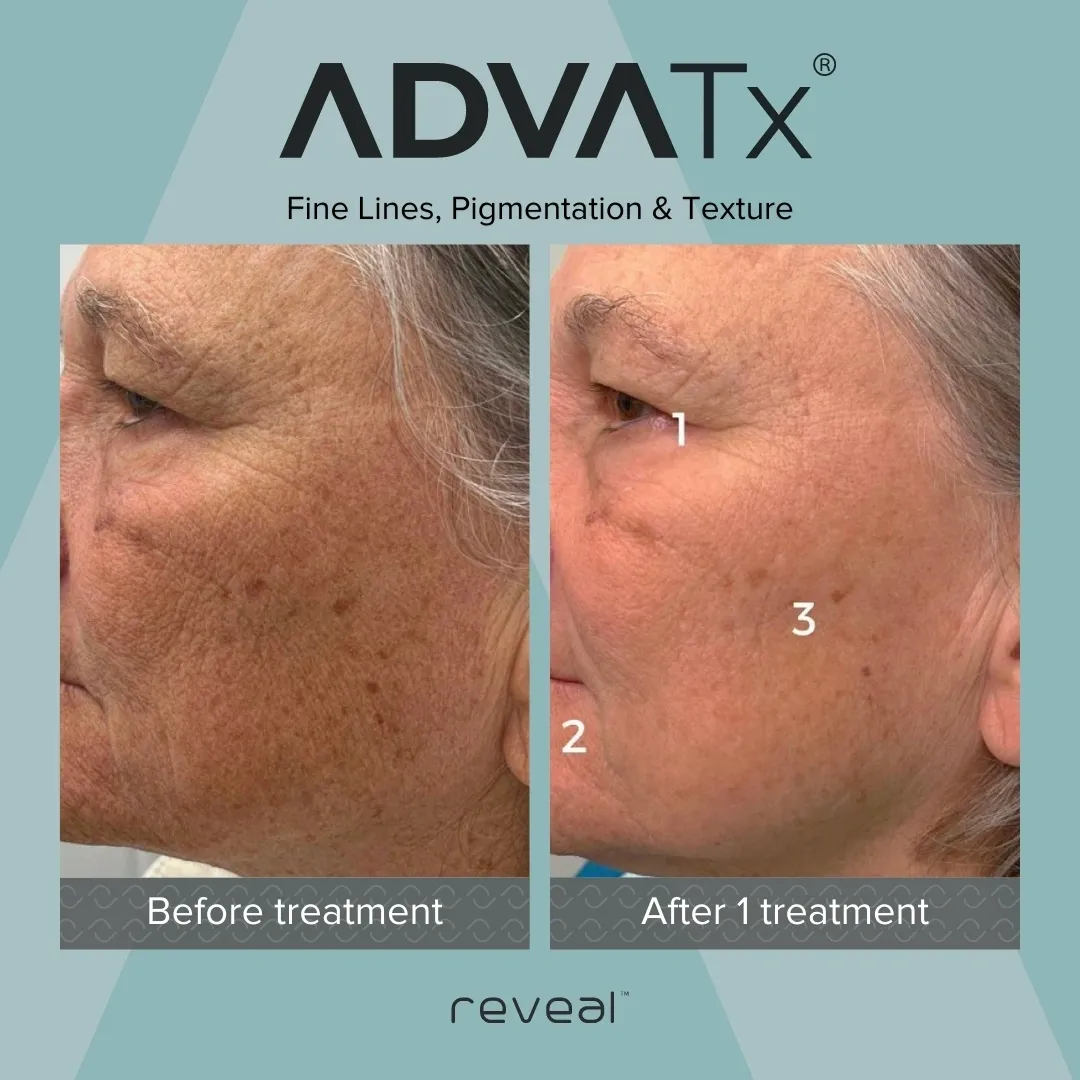 Be4 + after Template Link+FB - 28